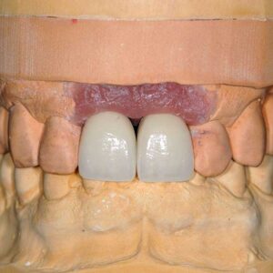 Implant Crowns