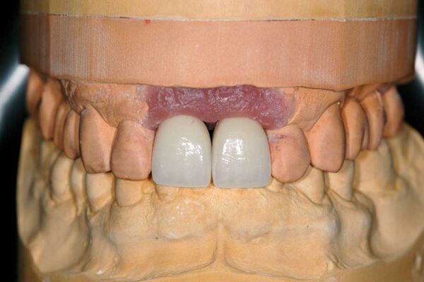 Implant Crowns