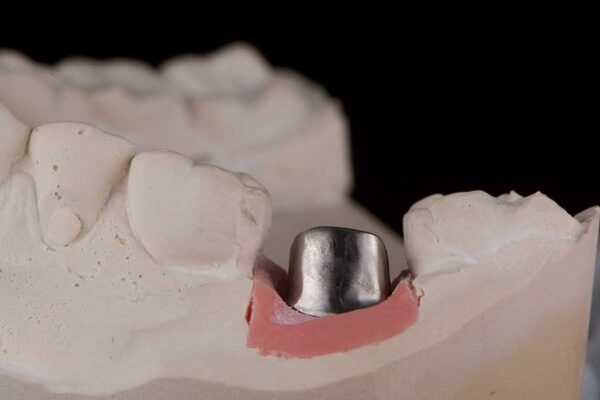 Custom Abutments