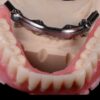 bar-over-dentures