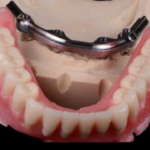 Bar Over-Dentures